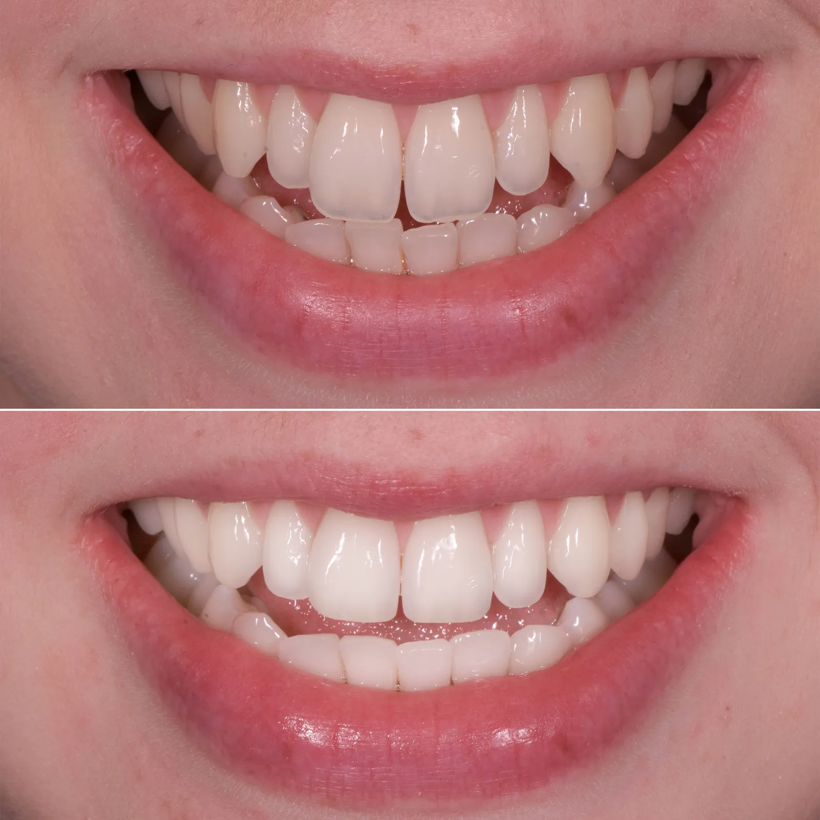 Teeth Whitening Treatment